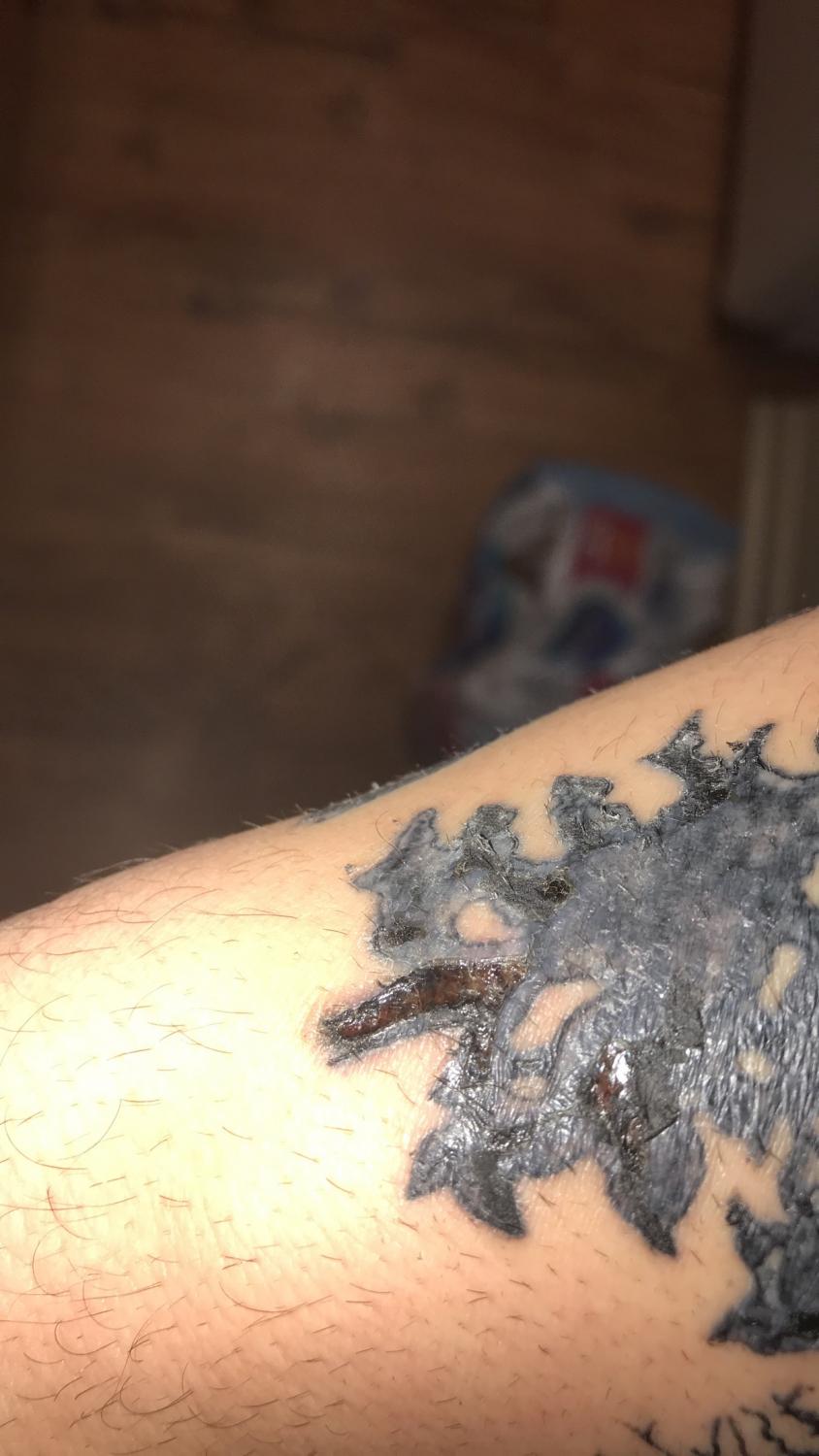 Infected Tattoo Stages Signs of Infection from Tattoos and After Tattoo  Removal  Removery