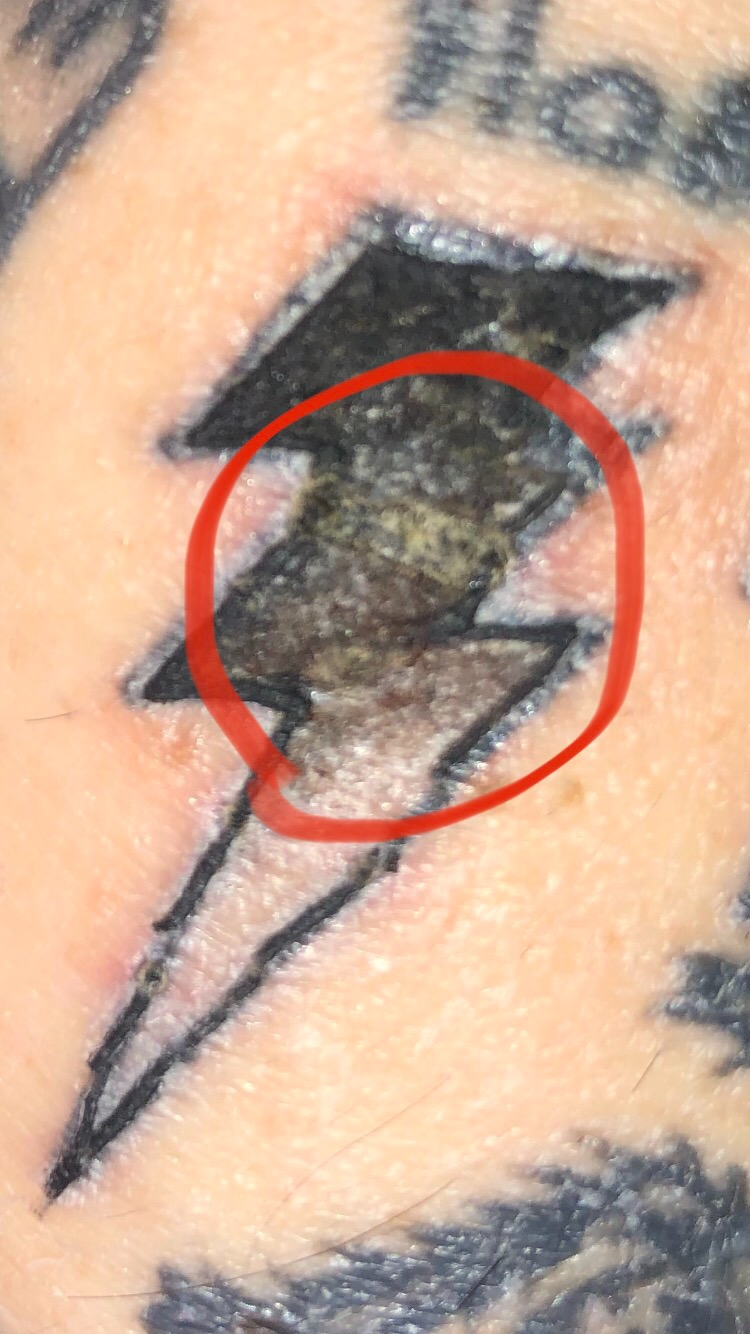 Is my tattoo infected Got it almost a week ago it was scabbing and got  like this after I applied some Aquaphor yesterday  rtattooadvice